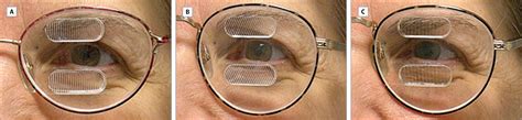 Peripheral Prism Glasses For Hemianopia Neuro Ophthalmology Jama Ophthalmology The Jama