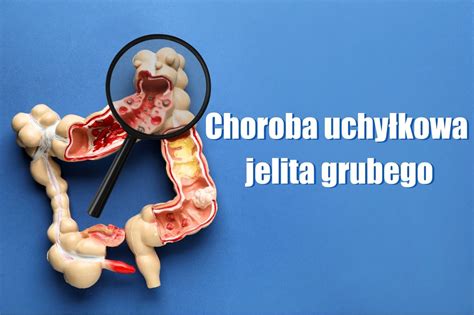 Leczenie choroby uchyłkowej jelita grubego Szpital Matki Bożej