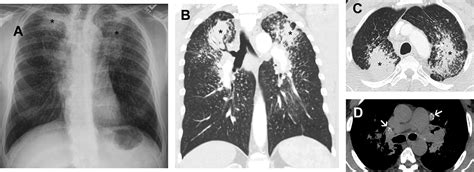 Imaging Patterns In Occupational Lung Disease—when Should I Consider Radiologic Clinics