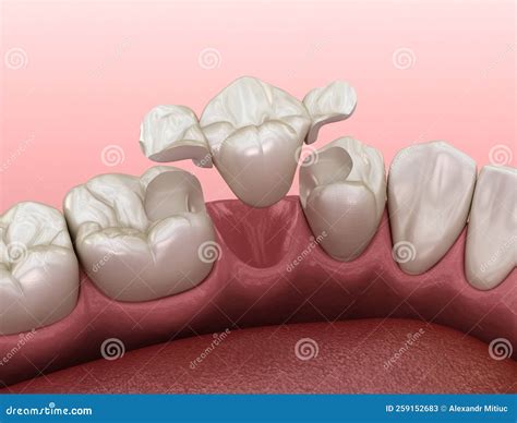 Maryland Bridge Made From Ceramic Premolar Tooth Recovery Medically