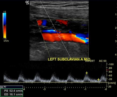 Subclavian Artery Ultrasound