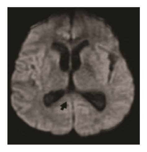 Mri Studies At Onset A C And 1 Month Follow Up D F Sagittal Fse T2