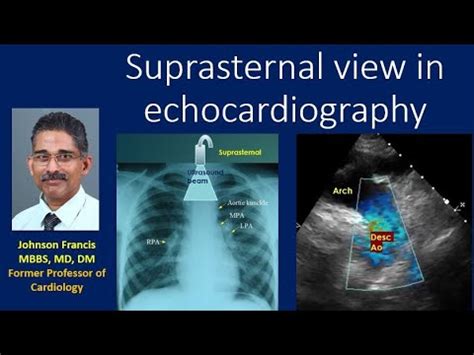 Suprasternal View In Echocardiography Youtube