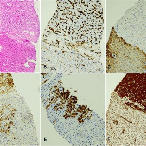 Core Needle Biopsy Of A 2 Cm Suspicious Liver Nodule Hematoxylin Eosin Download Scientific