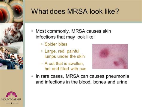 The Facts About Mrsa Ppt Video Online Download