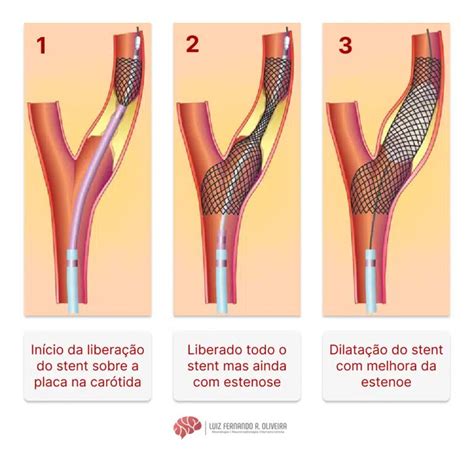 Angioplastia Da Car Tida Stent Tratamento Da Doen A Carot Dea