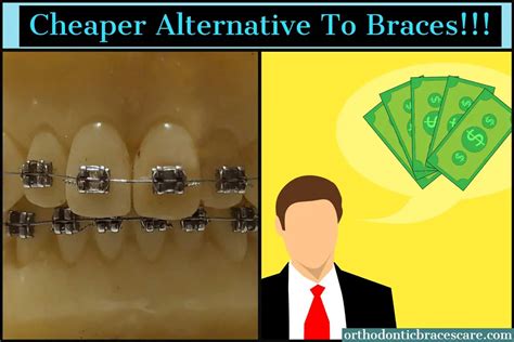 Is There A Cheaper Alternative To Braces - Orthodontic Braces Care