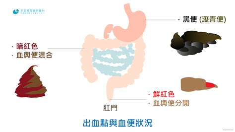 血便長怎樣 Cozyrewe