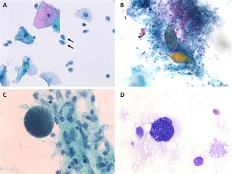 Bacterial Vaginosis Cytology