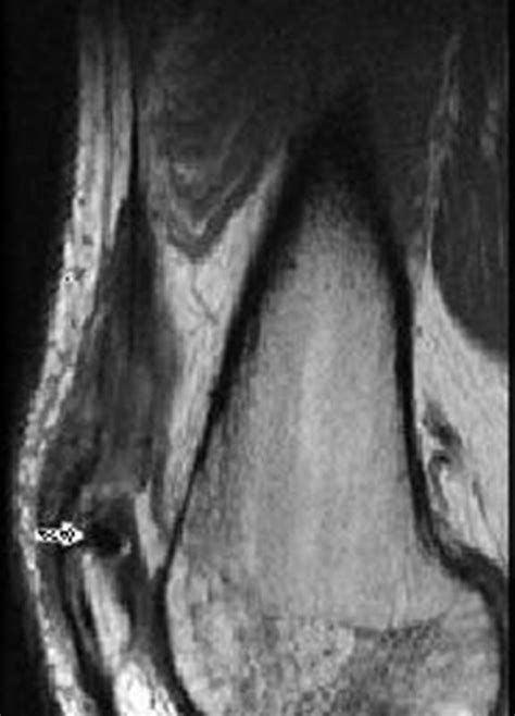 Sagitall Image Of The Vastus Lateralis Tendon Two Weeks Post Repair