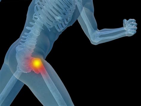 DePuy Pinnacle Hip Implant Defect Leads to Injuries, Lawsuit