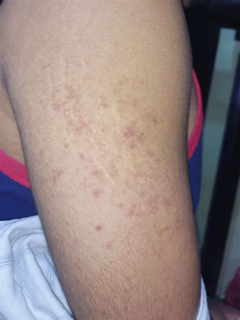 A 27 Year Old Male With A Bilateral Upper Arm Rash