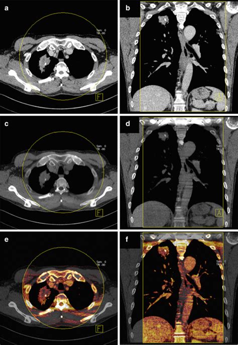 Dual Energy Ct In Chest Tumors Oncohema Key