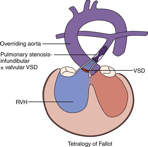 Tetralogy Of Fallot Animation