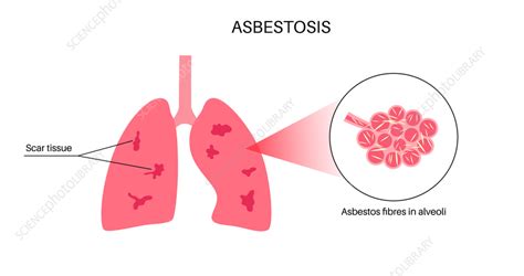 Asbestosis Lung Disease Illustration Stock Image F