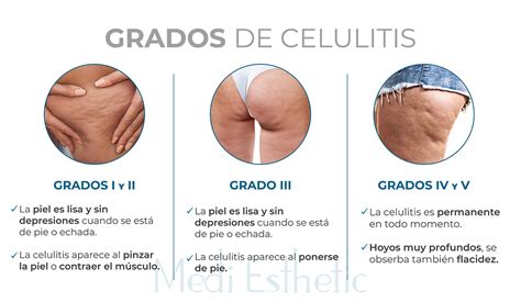 Qué es la celulitis y cómo combatirla