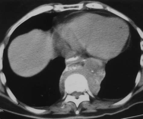 Amyloidosis Review And Ct Manifestations Radiographics