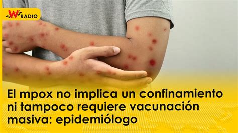 El mpox no implica un confinamiento ni tampoco requiere vacunación