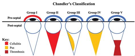 Orbital Cellulitis An Overview Of The Diagnosis And Management Eye News