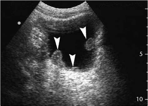 Multiple Transitional Cell Carcinomas Of The Bladder In A 74 Year Old Download Scientific