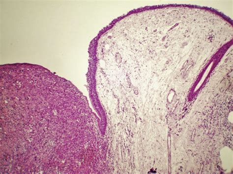 Undifferentiated High Grade Pleomorphic Sarcoma Of The Larynx Treated