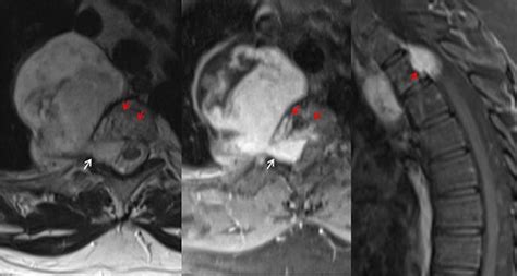 Large Thoracic Extradural Schwannoma Atypically Invading T Vertebra