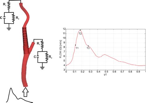 Figure 1 From Carotid Artery Hemodynamics Before And After Stenting A Patient Specific Cfd