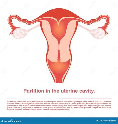 Uterine Septum Septate Uterus Female Reproductive System Front View