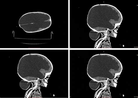 Sagittal Ct Scan Showing Hydranencephaly And Occipital Encephalocele