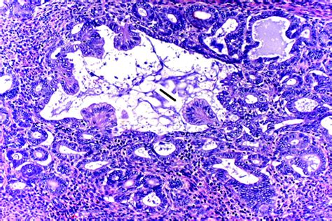 Endometrial Metaplasias And Reactive Changes A Spectrum Of Altered