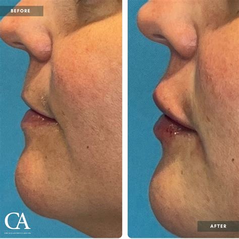 Lip Injections Before After Chicago Aesthetics Medspa