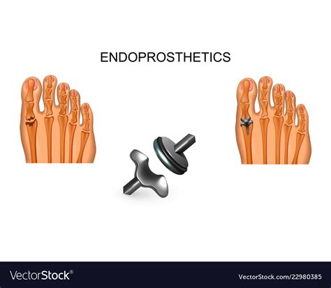 Big toe joint replacement Royalty Free Vector Image