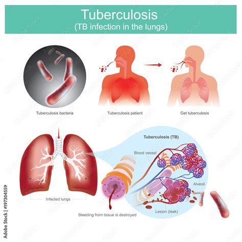 Tuberculosis Tb Infection In The Lungs Stock Vector Adobe Stock