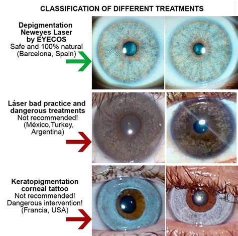 Cambio De Color De Ojos Despigmentaci N L Ser Versus