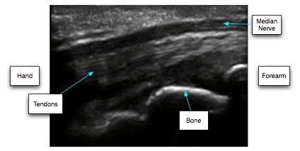 Ultrasound Measurements | Carpal-Tunnel.net