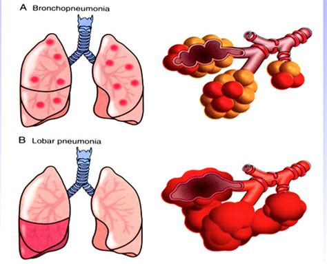 Cp2 413 Path Of Pneumonia Flashcards Quizlet