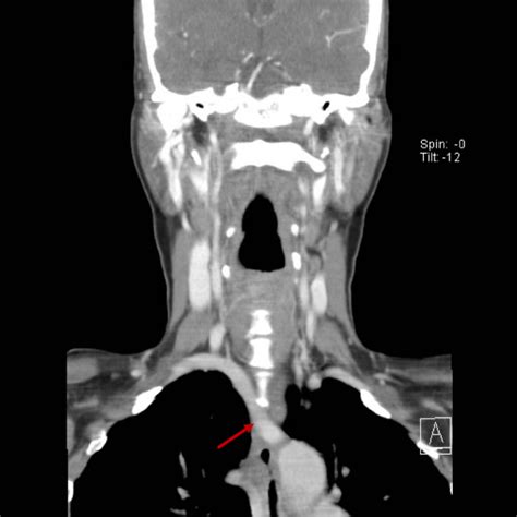 Dysphagia Lusoria A Rare Clinical Entity In The Adult Eurorad