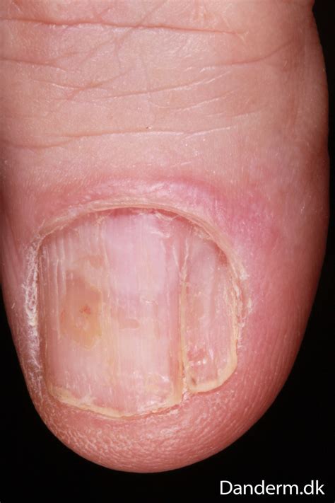 3 119 22 Lichen Planus Of A Nail