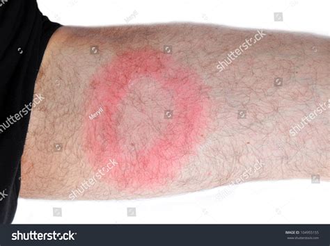 Lyme Disease Borreliosis Borrelia Typical Spot Stock Photo (Edit Now ...