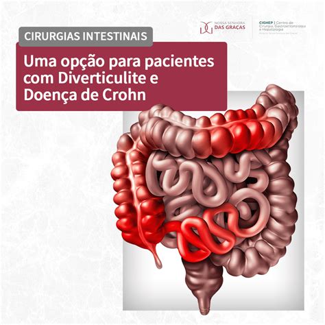 Cirurgias Intestinais Uma Op O Para Pacientes Diverticulite E