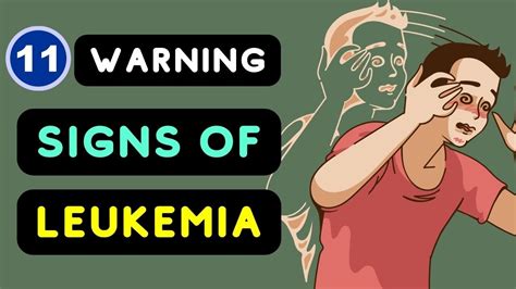 Leukemia Signs And Symptoms Top 11 Warning Signs Of Leukemia You