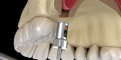 What is a Sinus Lift Procedure? Dentist in Houston 77042 Explains