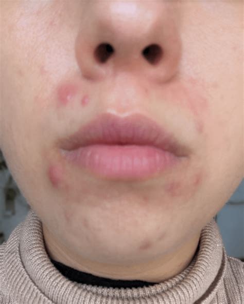 Acne Around Mouth And Chin Ive Tried Everything Help Racne