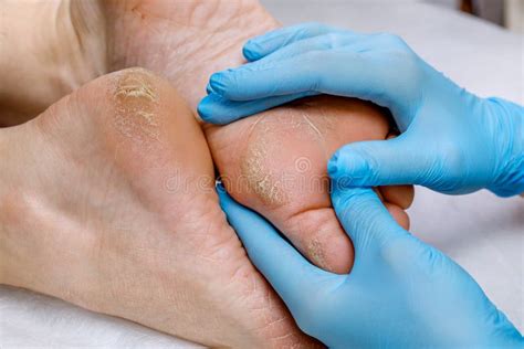 A Pedicure Doctor Examines A Patient`s Feet With Problematic Heels With