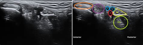 Tarsal Tunnel Ultrasound