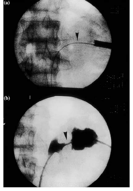 Dilation Of The Narrow Neck Of The Calyceal Diverticulum A Upper