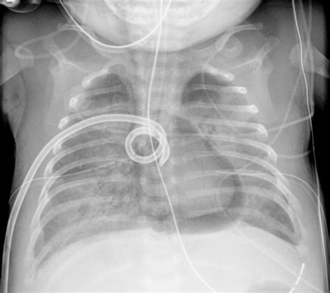 Pedi cardiology: X-ray: Pneumomediastinum vs. Pneumopericardium