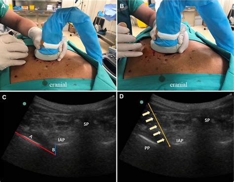 Figure 2 From Ultrasound Guided Extraforaminal Thoracic Nerve Root