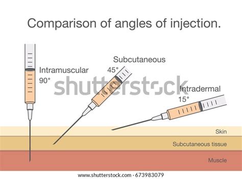 Comparison Angles Intramuscular Injection Ideal Medical 库存矢量图（免版税）673983079