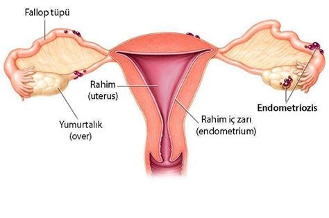 Endometriozis Nedir Belirtileri Nelerdir Nas L Tedavi Edilir